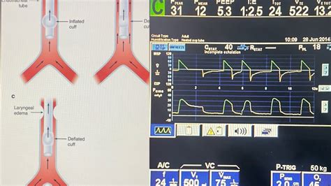 what is cuff leak test